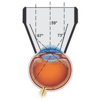 Opticlear Three Mirror Goniolens Glass Black Coated CE Certified Ophthalmic Diagnostic Lens Manual Instrument Set for Eye