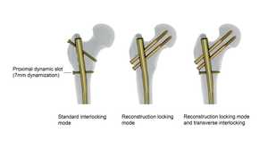 Clavo Intramedular Tibial Suprapatelar de Titanio de Grado Médico de Alto Rendimiento con Construcción Canulada - Product Image 5