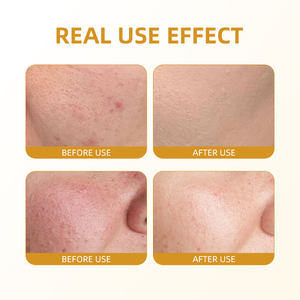 La piccola molecola polipeptide Gel lenitivo migliora l'irritazione della pelle, idrata, Anti-infiammatori e riduce rapidamente arrossamento - Product Image 5