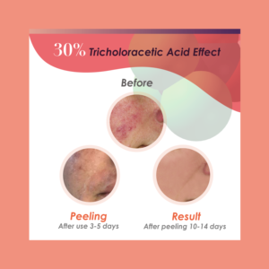 Élimine les rides profondes et les cicatrices d'acné, solution exfoliante pour la peau à 30 % d'acide trichloroacétique, rajeunit la peau. - Product Image 4
