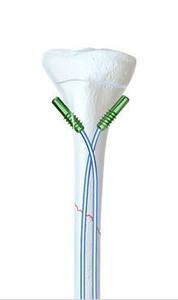 ตะปูยึดกระดูกแบบยืดหยุ่นทำจากไทเทเนียมสำหรับการผ่าตัดเด็ก โดย Surgiright Instruments - Product Image 6