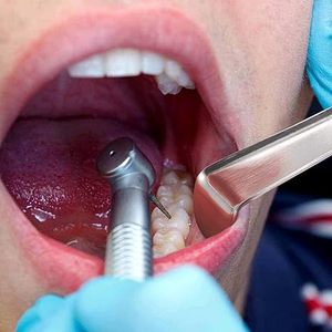 Retractor Bucal Profesional Minnesota, Retractor Quirúrgico Dental de Labios, Instrumento de Cirugía Oral de Acero Inoxidable, Aprobado por ISO - Product Image 3