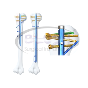 Professional Steel Medical Orthopedic Implant Multi-Lock Humeral Interlocking Nail Manual CE Certified By <b>Blush</b> Surgical - Product Image 1