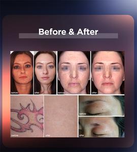 ADSS ND Yag Lasergerät zur Pigmententfernung, Augenbrauenreinigung & Tattooentfernung - Hochwertiges Tragbares Pico-Lasergerät - Product Image 6