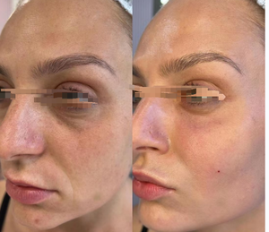 T Crème <span class=keywords><strong>Cosmelan</strong></span> <span class=keywords><strong>2</strong></span> pour soins à domicile 30ml Anti Taches de rousseur Soins de beauté - Product Image 4