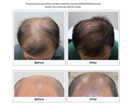 OEM PDRN Niacinamid Haarwuchs-Booster für Männer, Kopfhaut-Serum gegen Haarausfall, Private Label 40ml, Stimulierend für dünner werdendes Haar