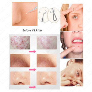 Extracteur de points noirs et d'acné en acier inoxydable, étanche, professionnel, avec logo personnalisé pour les soins de la peau (1 pièce) - Product Image 4