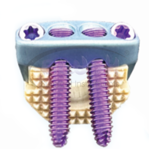 Implantes Ortopédicos de Acero Pfna, Clavo Intramedular Femoral, Manual, Duradero, con Certificación CE, para Fracturas Quirúrgicas, de Blush Surgical - Product Image 2