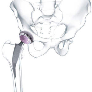 Implante de Reemplazo de Cadera, Cabeza Femoral Artificial y Prótesis de Vástago - Product Image 1