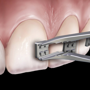 Pinzas de Precisión para Colocación de Brackets, Instrumento Dental de Ortodoncia, Acero Inoxidable, Profesional - Product Image 1