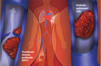 Tricoté transparent 20-30 MmHg Anti-Embolie Bas de cuisse Respirant et Gradué
