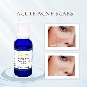 Elions Cosmeceuticals OEM 30% Prime Skin Peel Serum para Eliminar Cicatrices y Estrías, Blanqueamiento para Personas de Piel Oscura, Uso Profesional, Peeling - Product Image 6