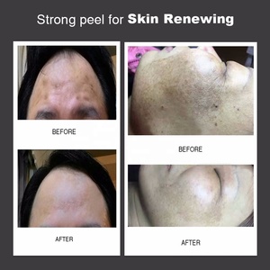 Etiqueta privada 7 días blanqueamiento de la piel Peeling Aqua Laser ácido de caña de azúcar con ácido hialurónico y juego de belleza a base de hierbas - Product Image 3