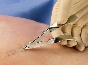 Skin <b>Staple</b> stitches Remover stainless steel surgical instruments - Product Image 4