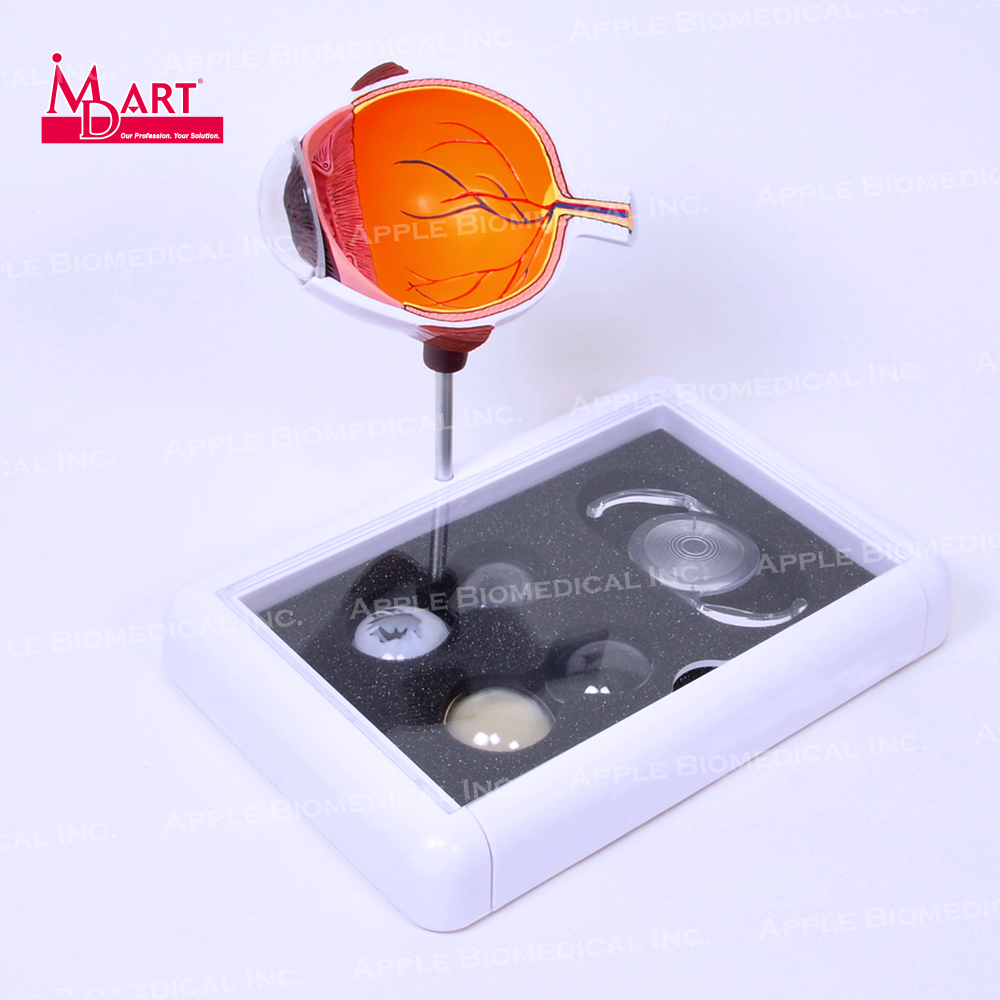 Офтальмологическая модель человеческого анатомического глаза с различными заболеваниями линз и ол