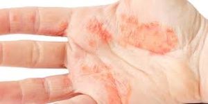 Crema prurito naturale dermo Made in Italy per screpolature, scottature, pelle irritata per uomini, donne e bambini - Product Image 3