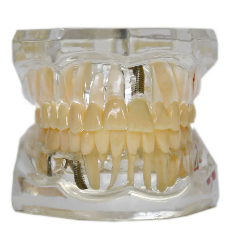 インプラントネイルと歯の病変を示すカスタム口腔歯科透明歯モデルの製造ベージュ色