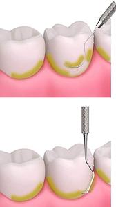 Meilleur kit d'hygiène dentaire blanchissant les dents, ensemble de détartrage, outils de nettoyage dentaire 2026 - Product Image 6