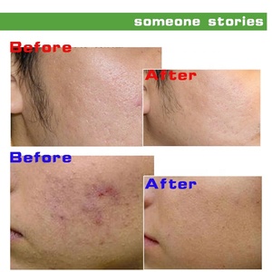 Éliminez l'hyperpigmentation tenace grâce aux peelings chimiques à 20 % pour éclaircir la peau. - Product Image 3