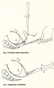 Pince obstétrique Barton une lame articulée 35.5cm en acier inoxydable Mahersi - Product Image 4