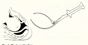 Pince obstétrique Barton une lame articulée 35.5cm en acier inoxydable Mahersi - Product Image 2