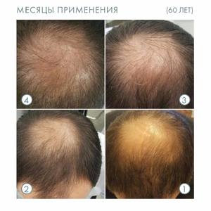 Nouveau produit 2021 Crème anti-âge 5% Complexe Capixil pour la perte de cheveux et la thérapie de repousse des cheveux Meilleur fournisseur russe Prix bas - Product Image 4