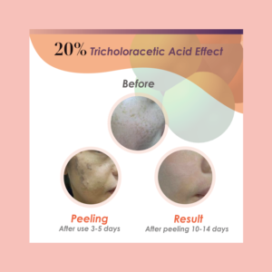 Elimina las arrugas profundas, corrige la hiperpigmentación persistente, peeling renovador de piel con ácido tricloroacético al 20% - Product Image 3
