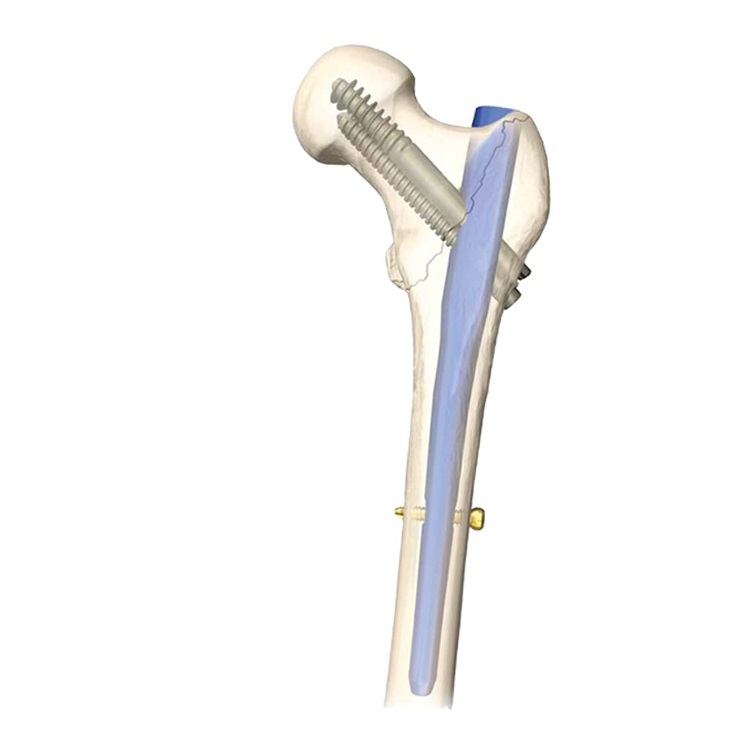 Интрамедуллярный (внутрикостный) остеосинтез. Интрамедуллярный (внутрикостный) остеосинтез. Pfna synthes. Интрамедуллярный остеосинтез шейки бедра. Блокируемый штифт для остеосинтеза.